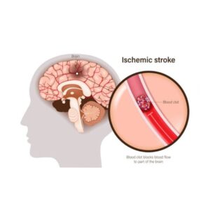 Ischemic Stroke